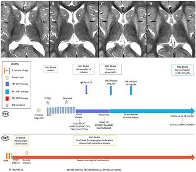 Case Report: The JAK-Inhibitor Ruxolitinib Use in Aicardi-Goutieres Syndrome Due to ADAR1 Mutation